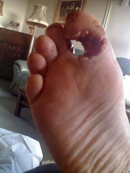 steel toe accident 2