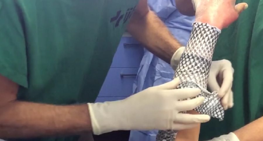 fish skins for first aid
