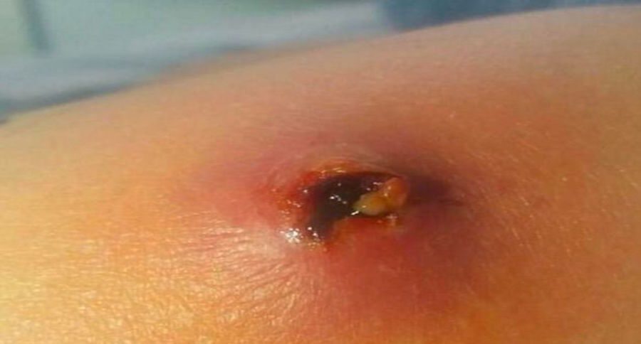 spider bite