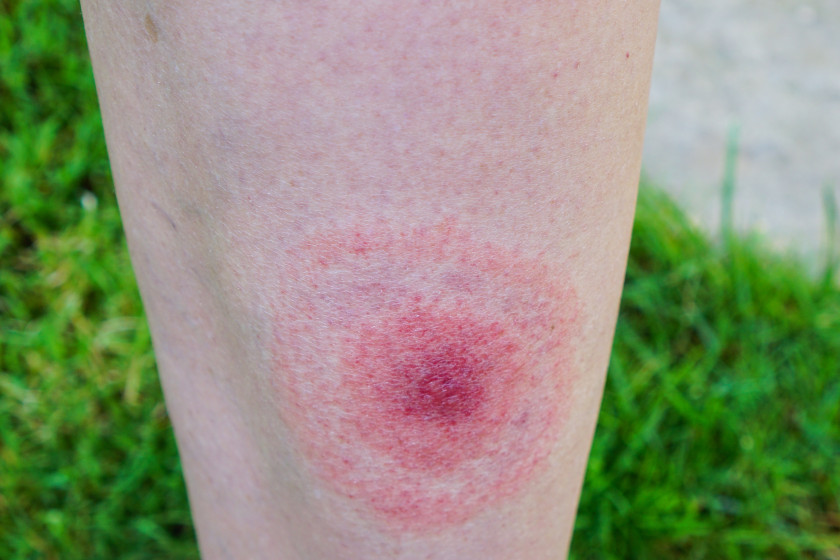 Lyme Disease