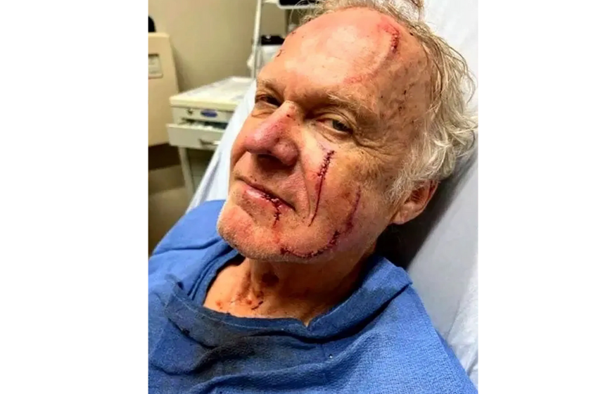 Bill Palas after being stitched up