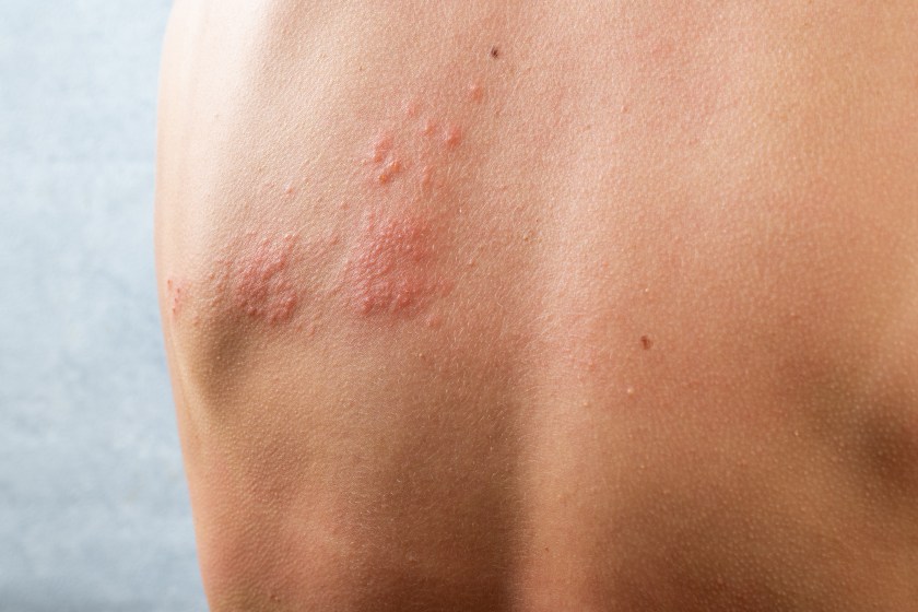 Skin infection rash poison ivy