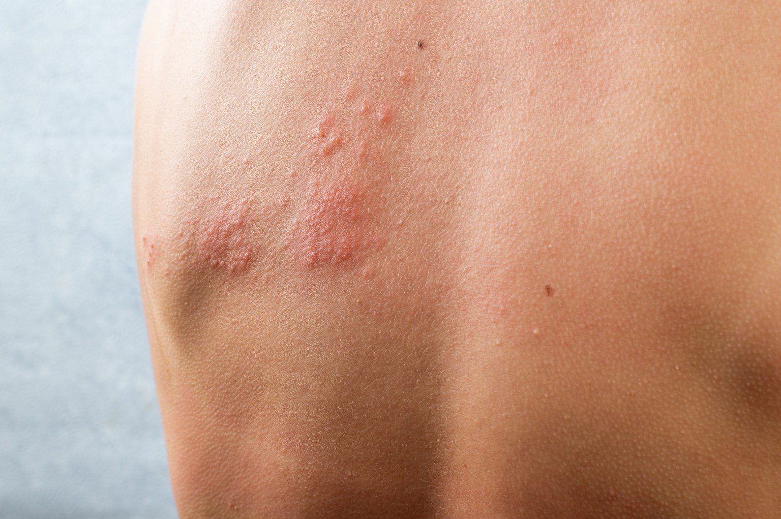 Natural Remedies for Poison Ivy Baking Soda, Aloe, Witch Hazel