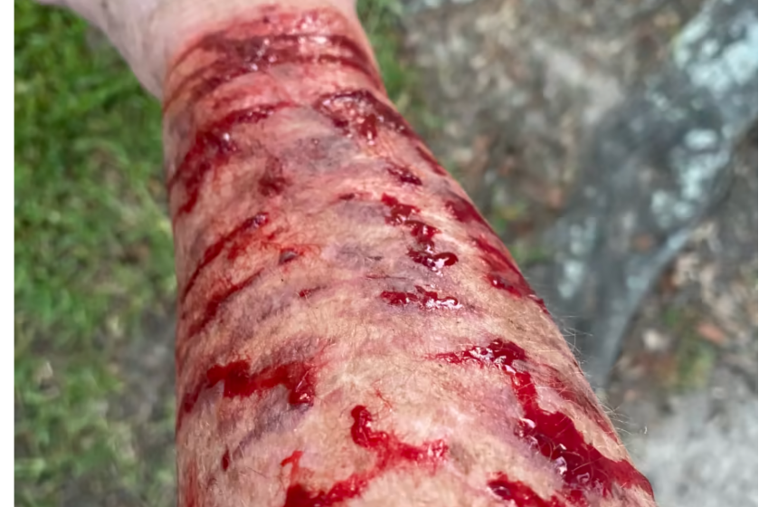 Peggy Jones shows the aftermath of her hawk attack.