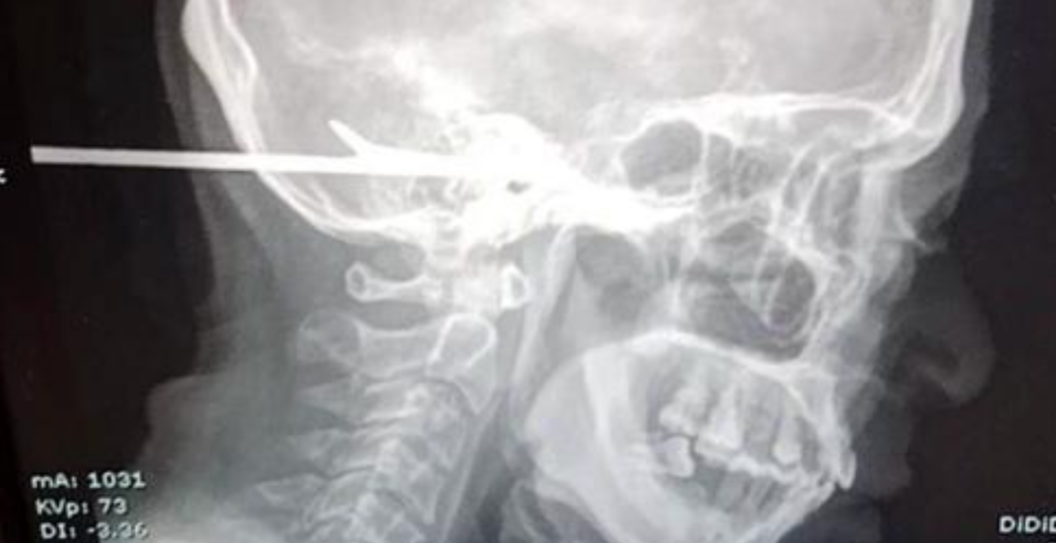 fisherman attacked by friend with harpoon
