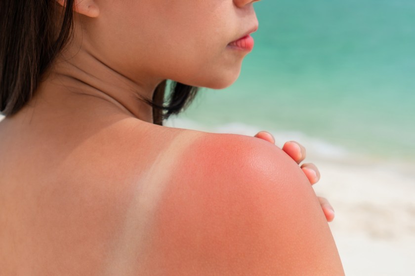 sunburn